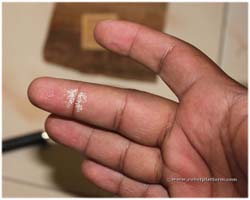 Peroxide contacted and finger burnt